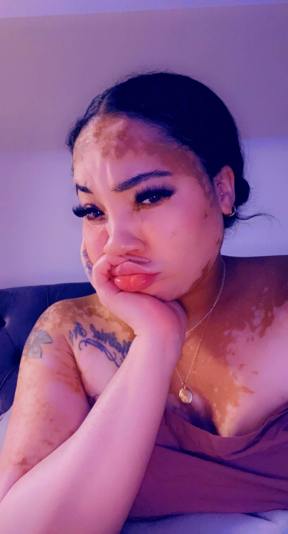 Vitiligo Bae OnlyFans – free nudes, naked, leaked