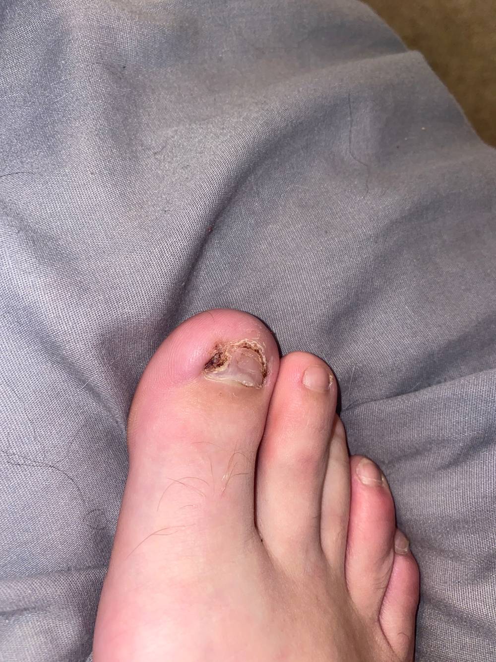 Ingrowntoenails