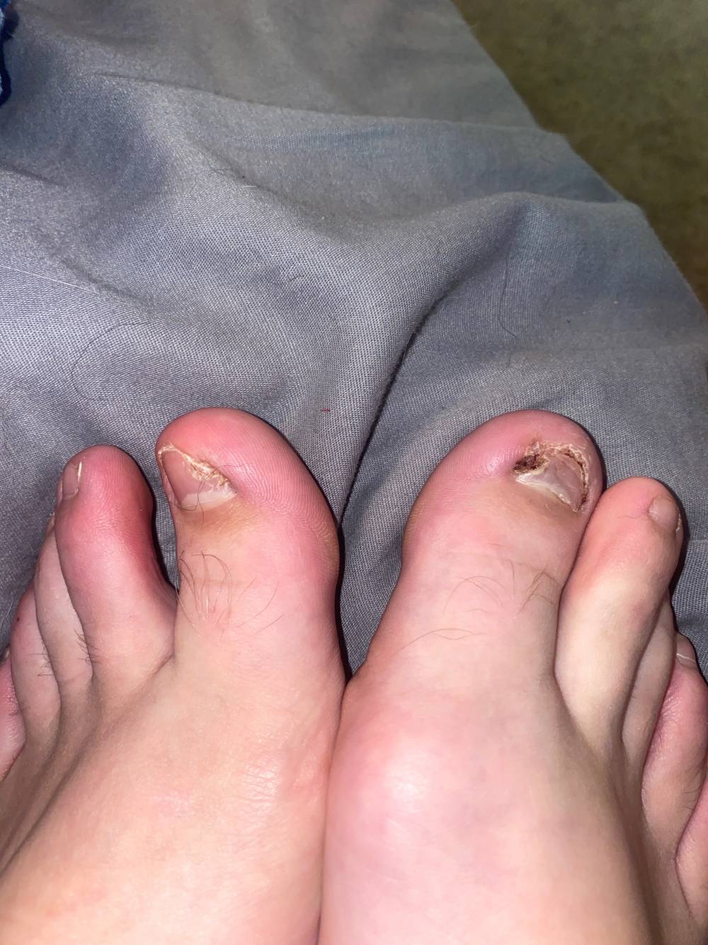 Ingrowntoenails